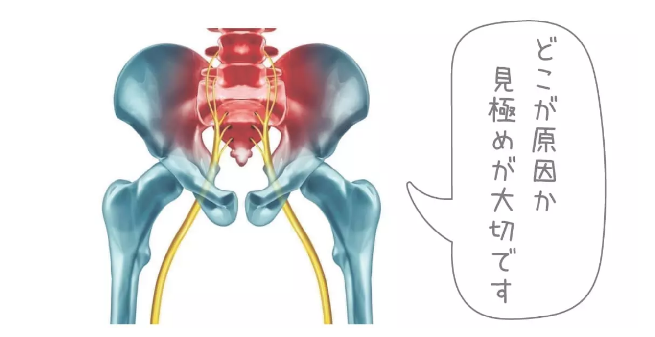 坐骨神経痛の原因